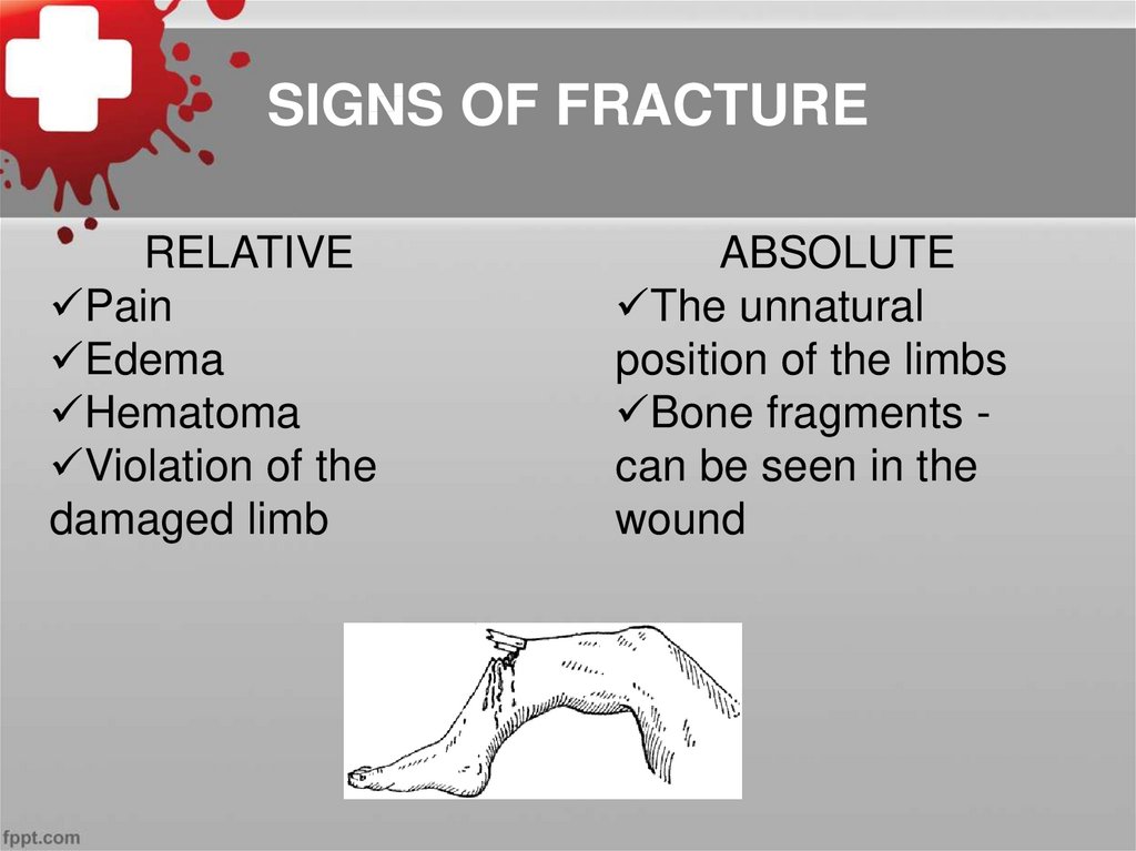 SIGNS OF FRACTURE