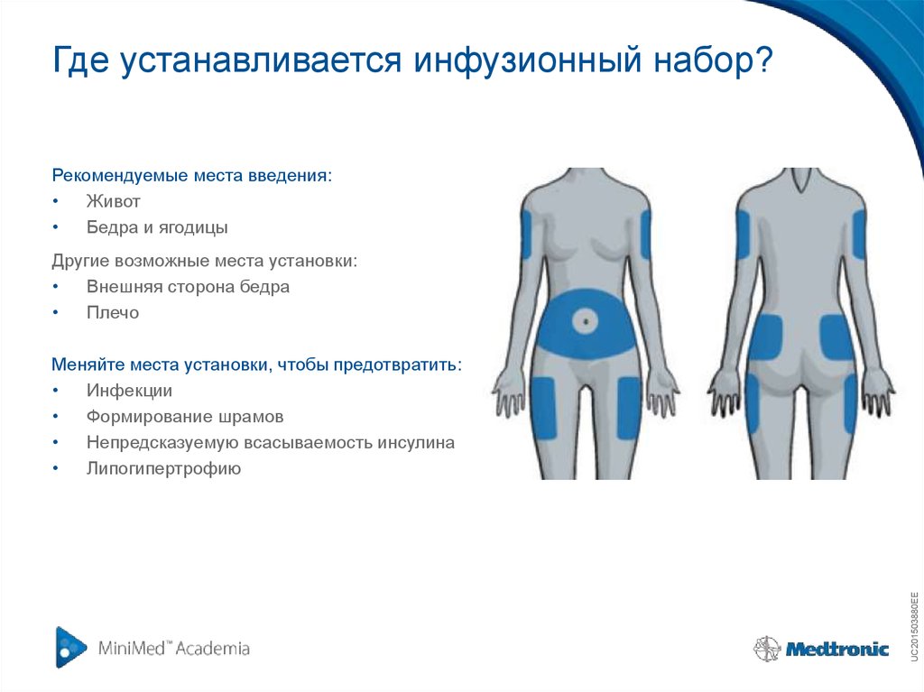 Где устанавливается. Места для установки инфузионного набора. Места для установки инсулиновой помпы. Места установки инфузионного набора к помпе. Места для установки канюли.