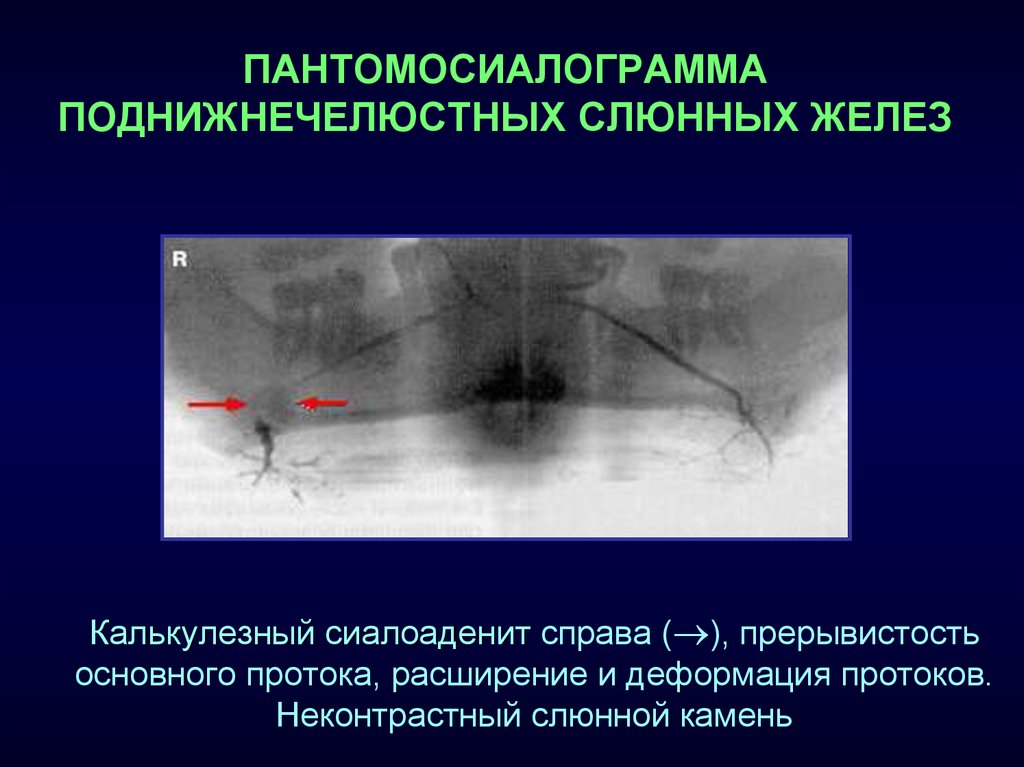 Лучевая диагностика заболеваний слюнных желез презентация