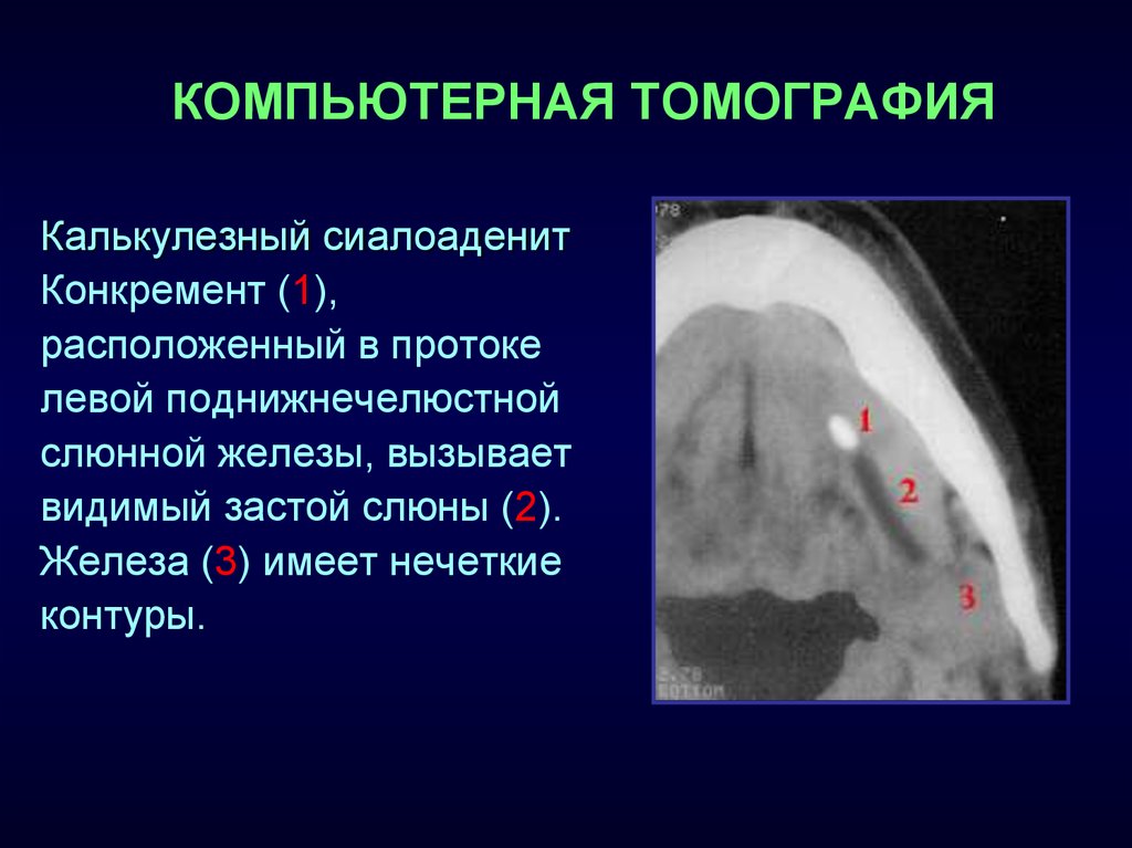 Сиалоаденит код