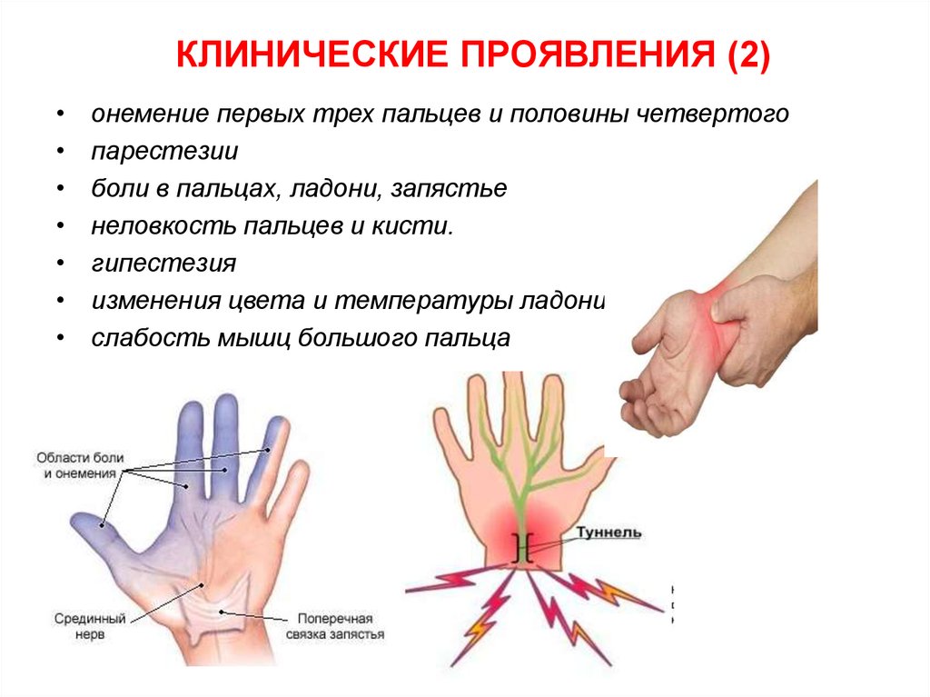 Онемение пальцев после операции. Туннельный синдром кисти руки симптомы. .Туннельный синдром запястья туннельный. Симптомы туннельного синдрома запястного канала. Туннельный синдром лучезапястного сустава.