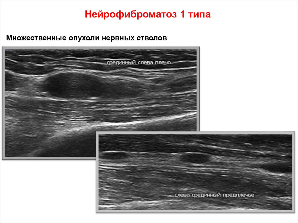 Нейрофиброматоз 1 типа
