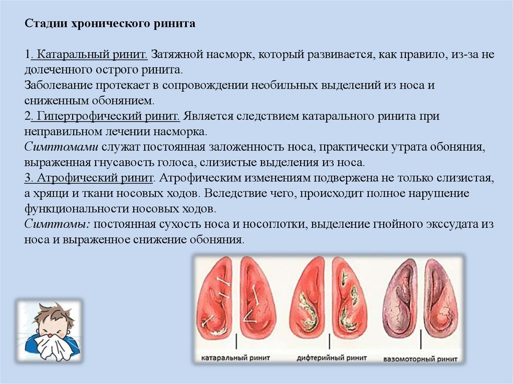 Что такое хронический ринит