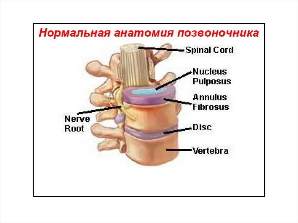 Остеохондроз позвоночника презентация