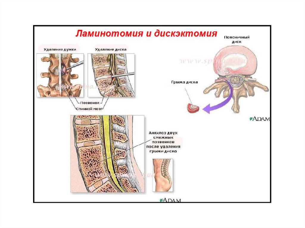 Дискэктомия поясничного отдела позвоночника схема операции