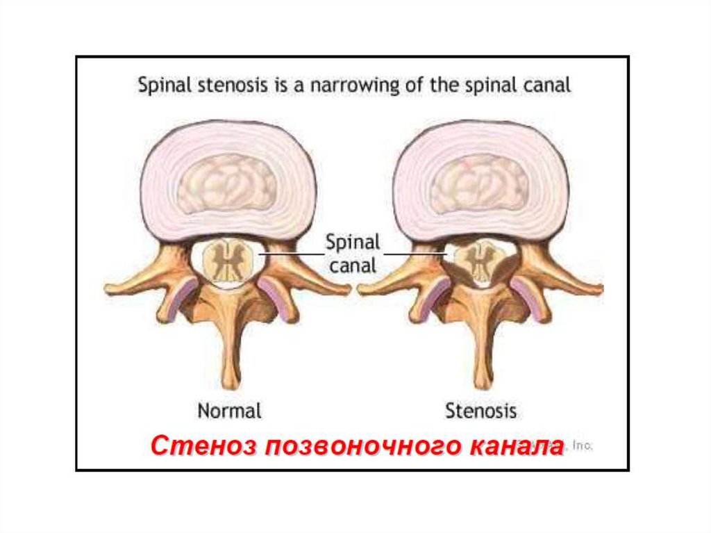 Стеноз позвоночного канала поясничного отдела в картинках