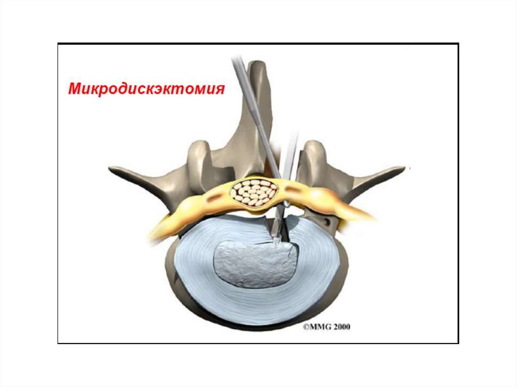 Дискэктомия поясничного отдела позвоночника схема операции