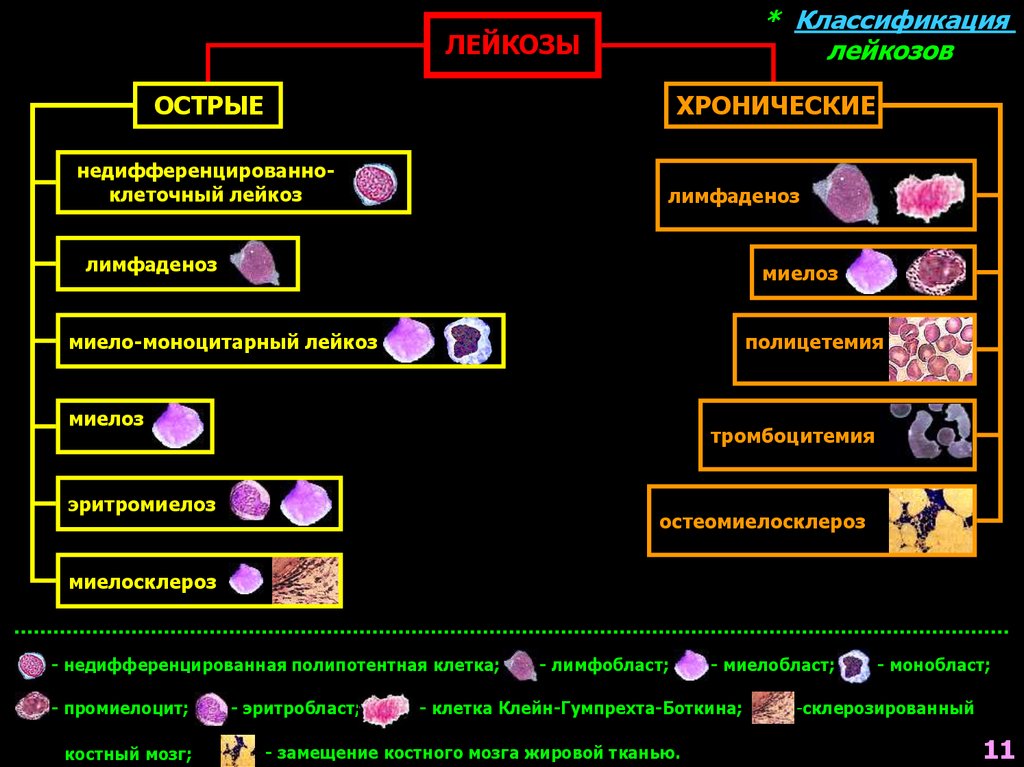 Механизм развития лейкопении. Хронические лейкозы классификация. Классификация острых лейкозов. Острый лейкоз классификация схема. Классификация лейкозов схема.