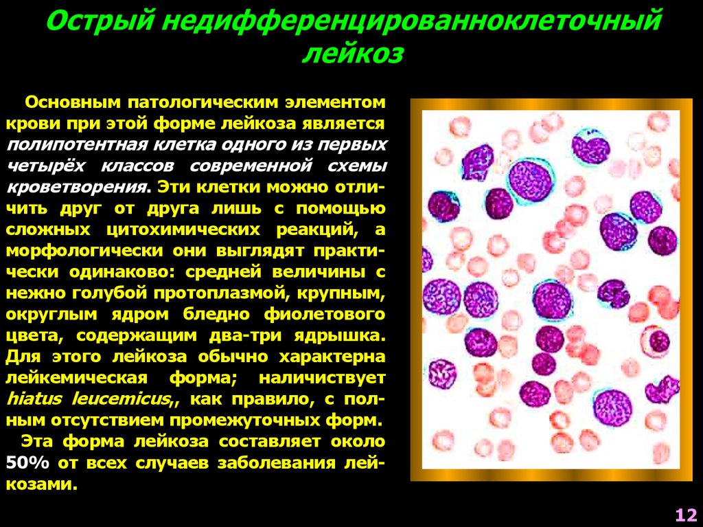 Миелолейкоз