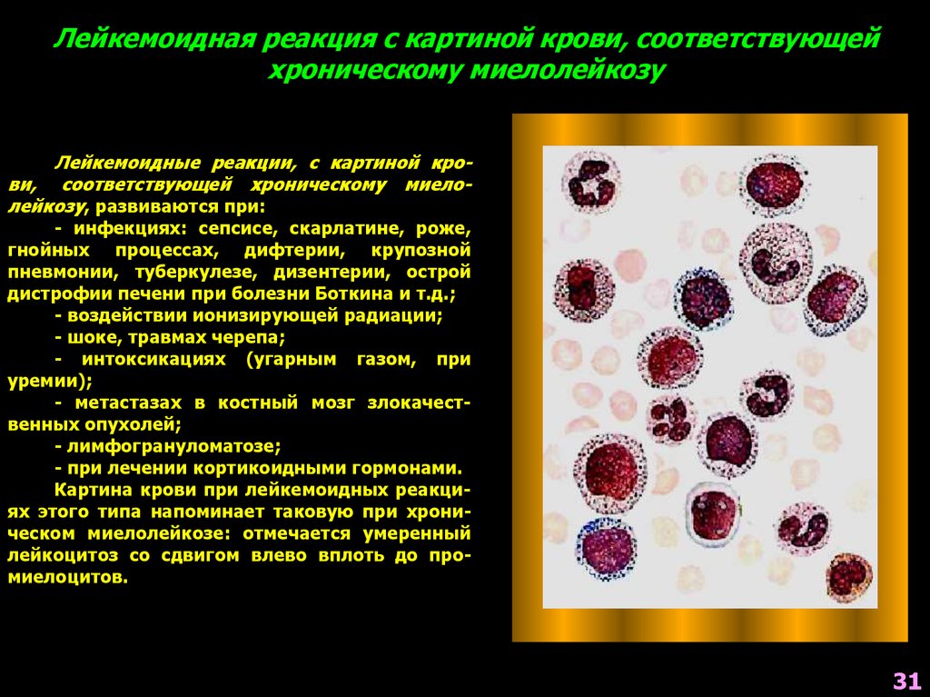 Лейкоцитоз что это за болезнь. Моноцитарный лейкоцитоз. Моноцитарный лейкоз картина крови. Картина крови при моноцитарном лейкозе. Лимфоцитарный лейкоцитоз.