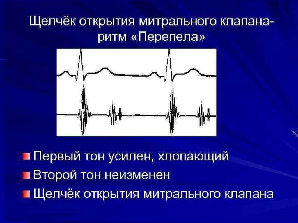 Аускультативная картина при митральном стенозе сердца включает