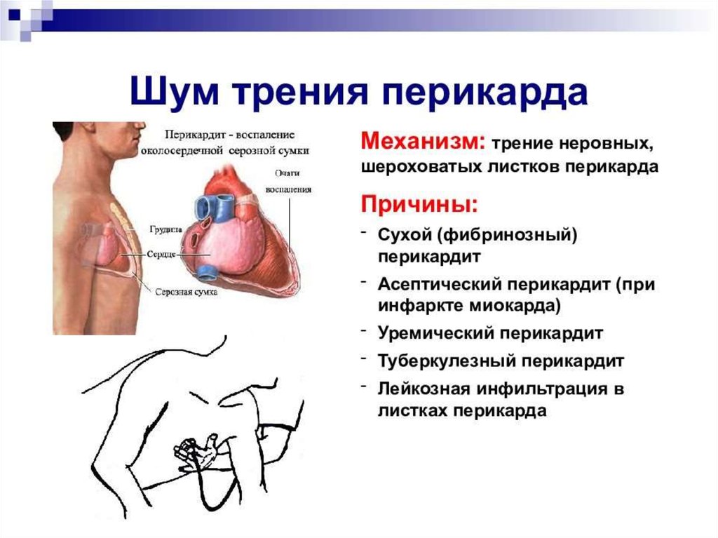 Шумы в сердце. Шум трения перикарда механизм образования. Шумы при сердечной недостаточности. Аускультация сердца сердечные шумы. Причины шумов в сердце.