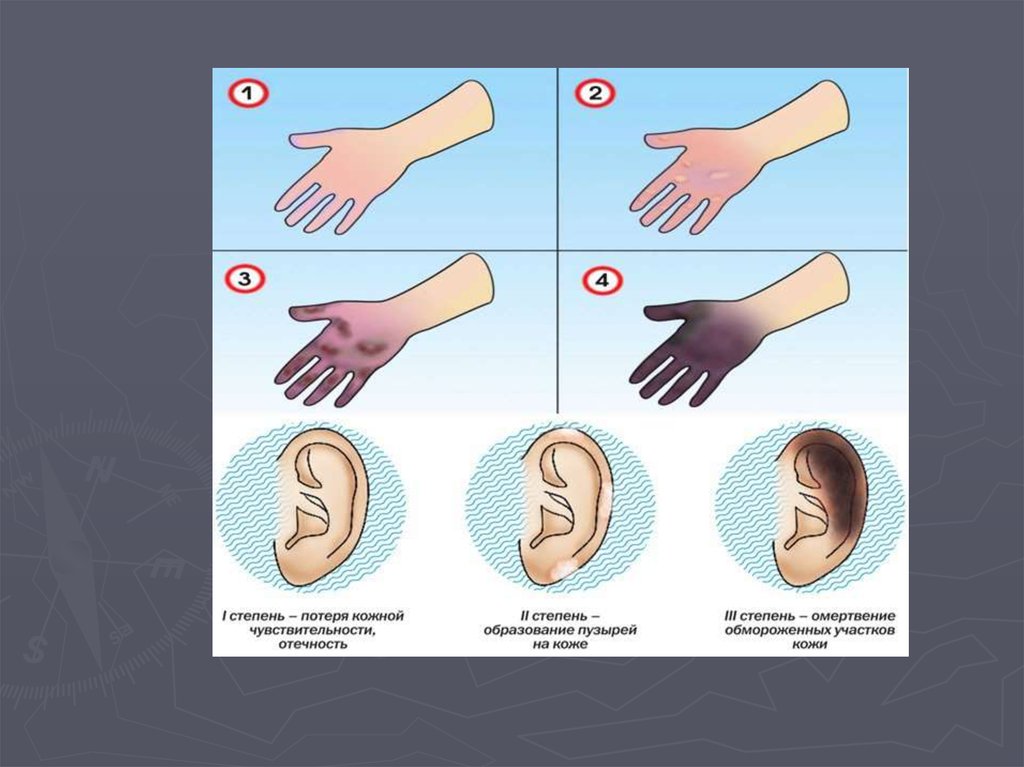 Первая стадия. Первая степень отморожения. Отморожение степени тяжести. Обморожение 1 2 3 степени. Обморожение первой степени.