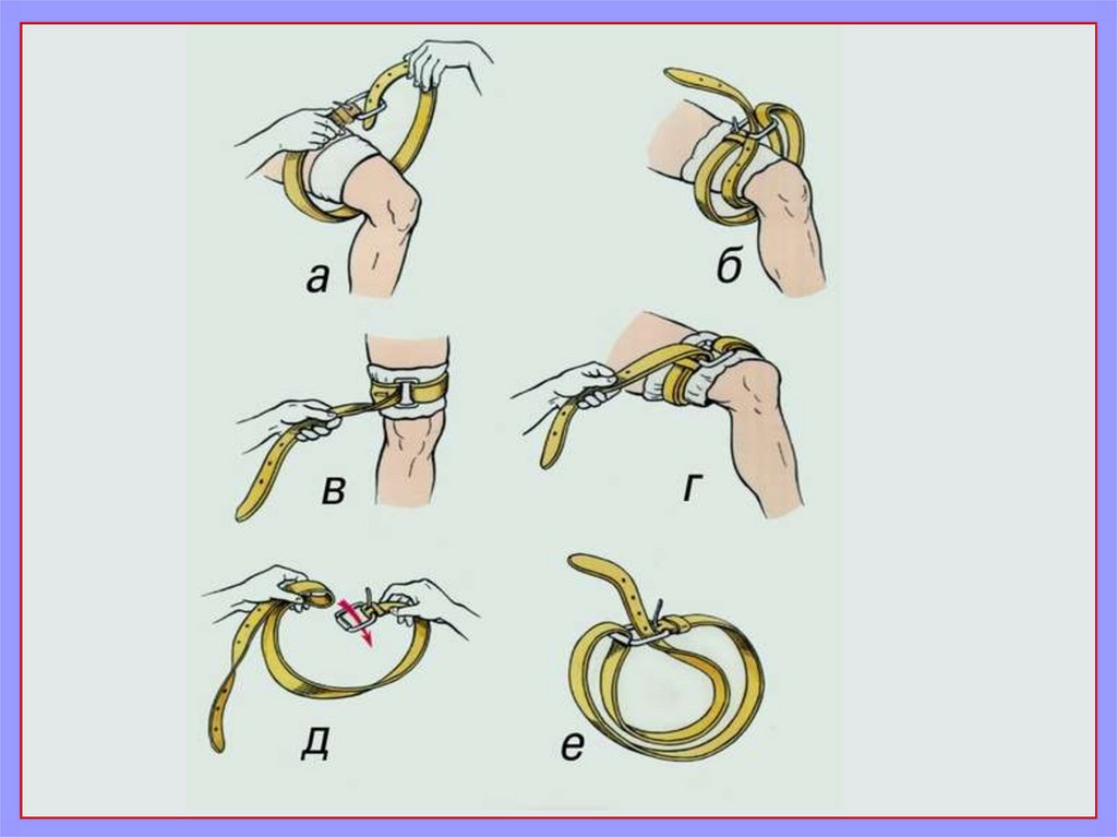 Правильный жгут. Техника наложения жгута Эсмарха. Наложение кровоостанавливающего жгута Эсмарх. Техника наложения кровоостанавливающего жгута жгута. Методика наложения кровоостанавливающего жгута.