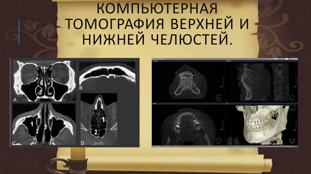 Компьютерная томография верхней и нижней челюстей.