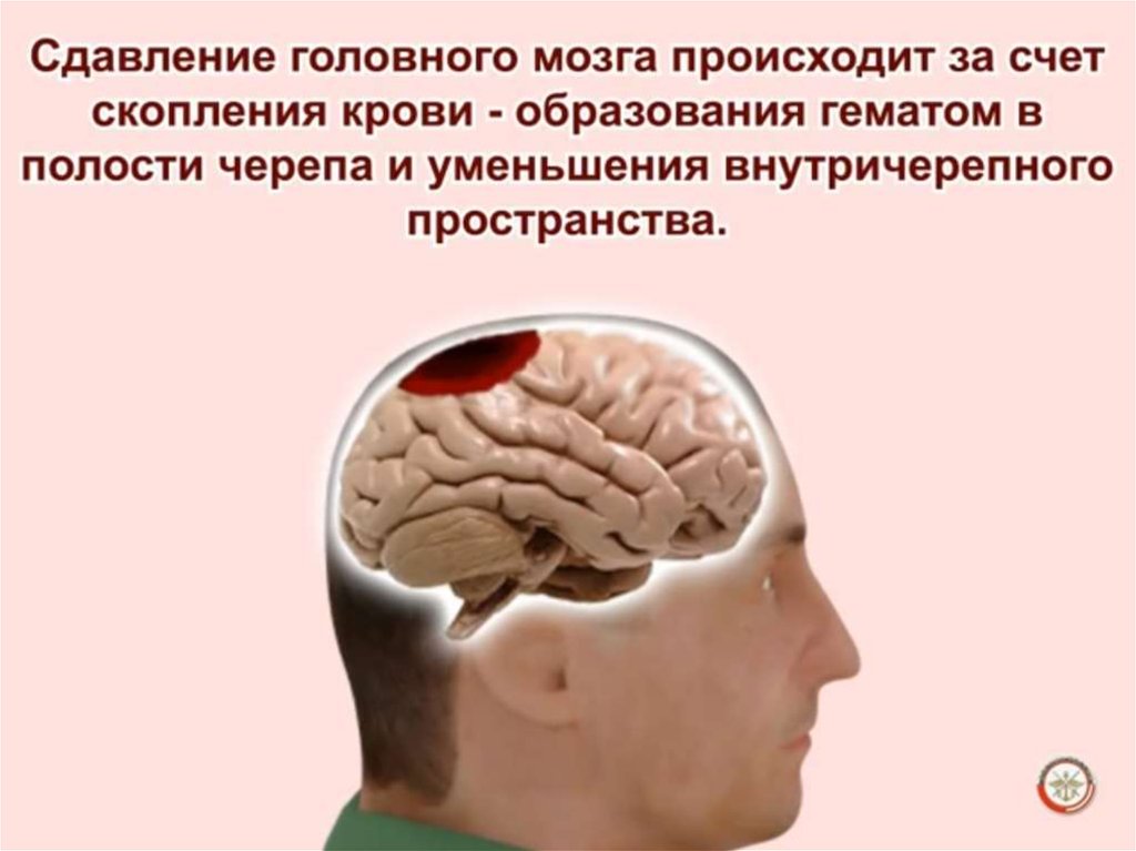 Сдавление мозга признаки. Черепно-мозговая травма сотрясение головного мозга. Травмы головноготмозга. Сотрясение сдавление головного мозга. Повреждения черепа и головного мозга.