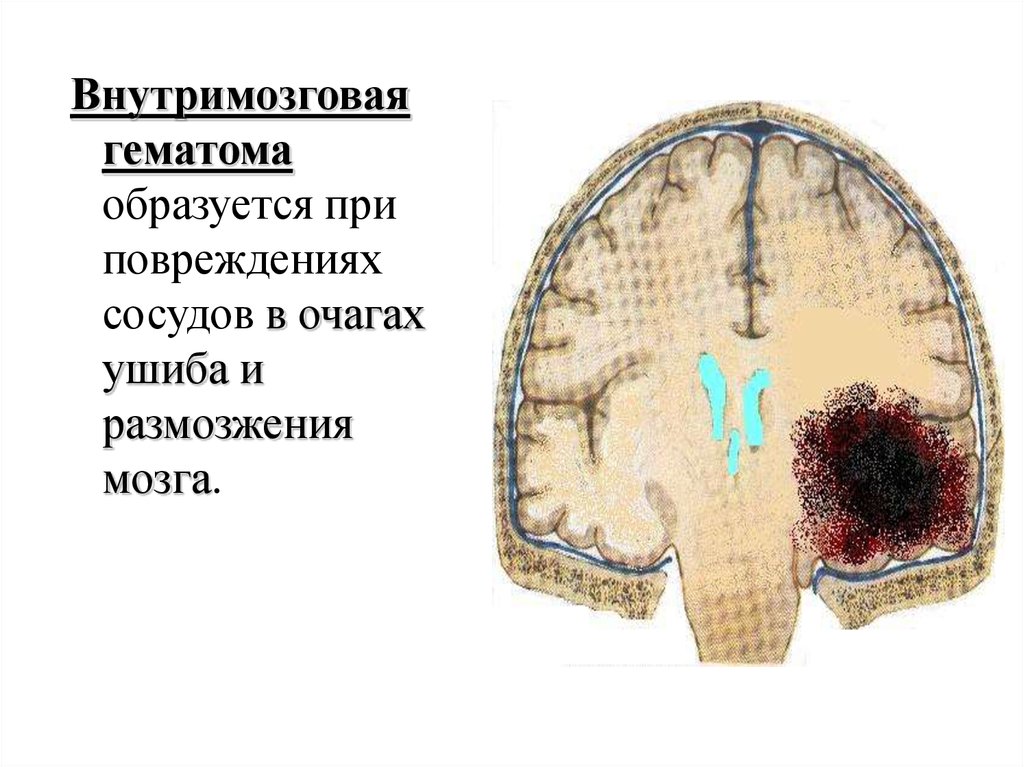 Гематома черепно мозговой травме. Гематома в головном мозге. Внутримозговая гематома. Локализации внутримозговых гематом. Внутримозговая гематома мозга.