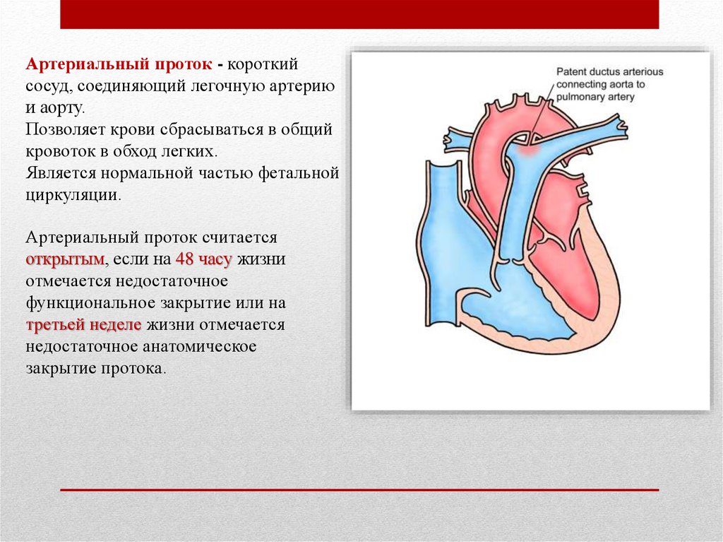 Открытый артериальный проток картинки