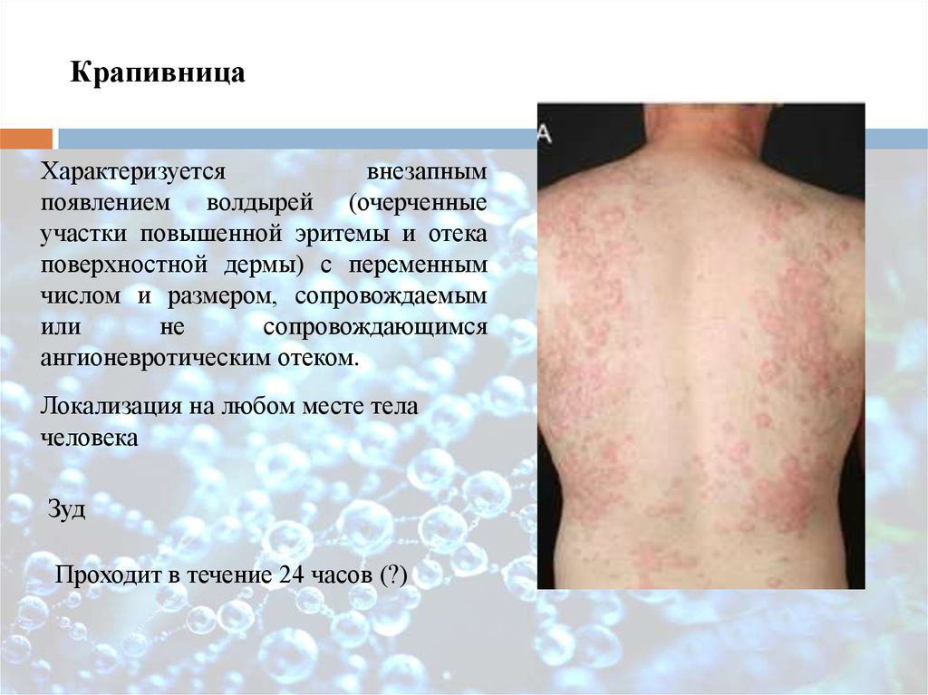 Реакции гиперчувствительности кожи (CDHR). Реакции гиперчувствительности  кожи к лекарствам (DHR) - презентация онлайн