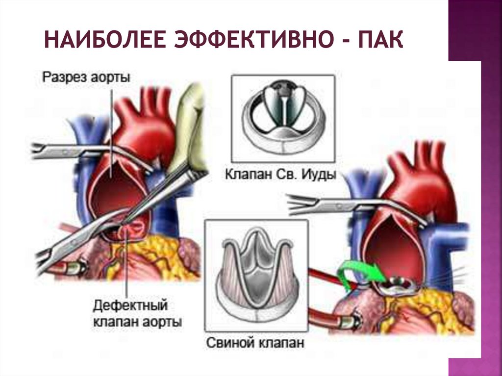 Как клапан делает операция. Операция на сердце аортальный клапан. Аортальный клапан сердца протез. Аортальный стеноз протезирование. Стеноз двустворчатого аортального клапана.
