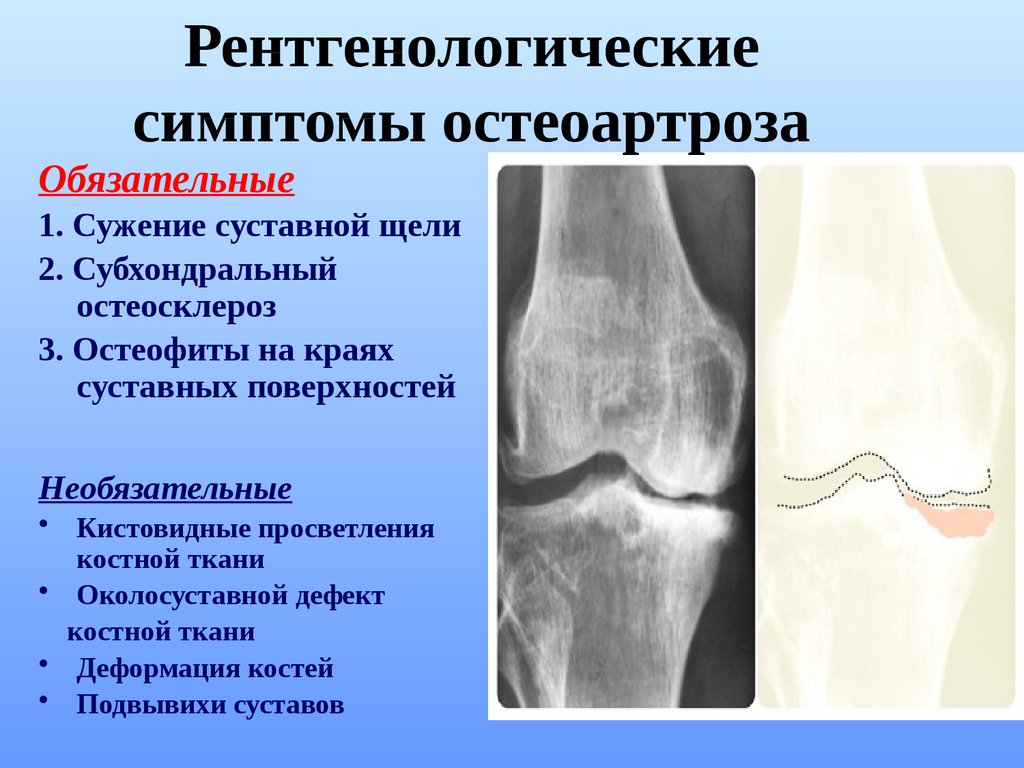 Сустав деформирован. Остеофиты коленного сустава рентген. Субхондральный остеосклероз рентген. Остеосклероз коленного сустава рентген. Рентген остеосклероз костной ткани.