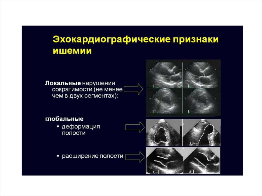 Локальная сократимость лж. ЭХОКГ признаки ишемии миокарда. ЭХОКГ инфаркт миокарда. Эхокардиография при ишемической болезни сердца. Вазоспастическая стенокардия ЭХОКГ.