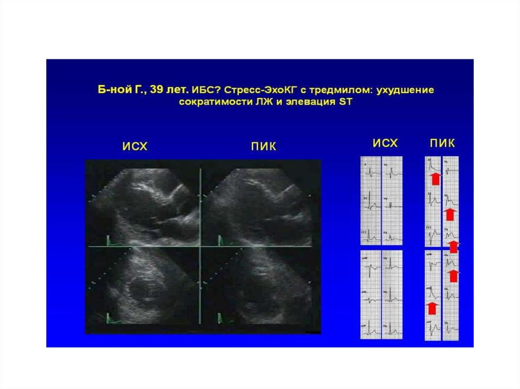 Стресс эхокг презентация