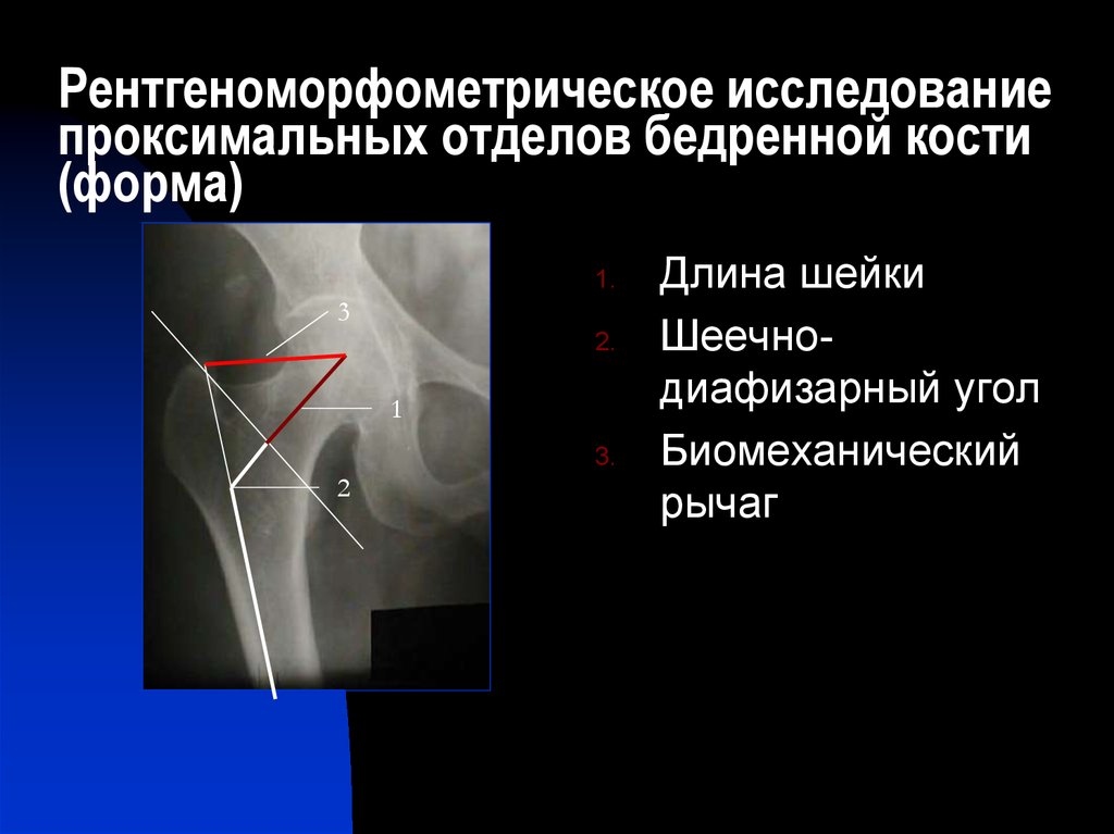 Проксимальный отдел бедренной кости