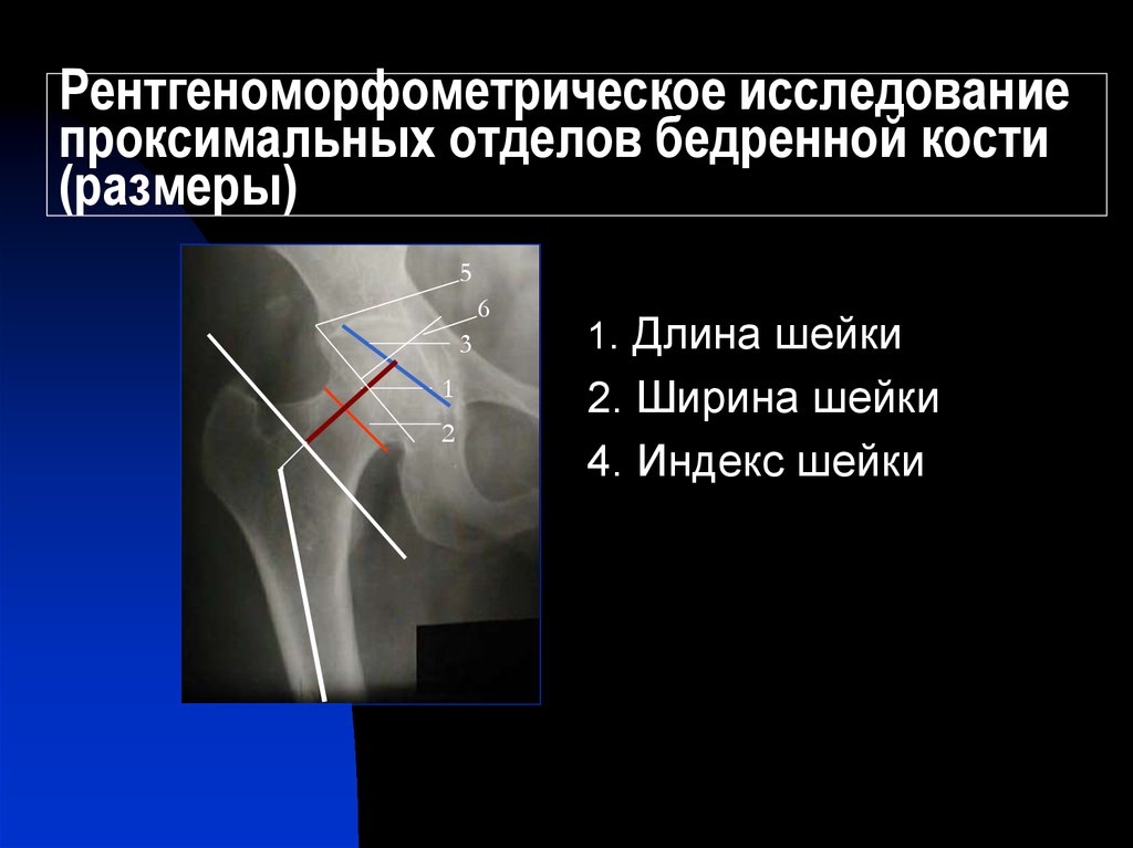 Проксимальный отдел бедренной кости где находится фото