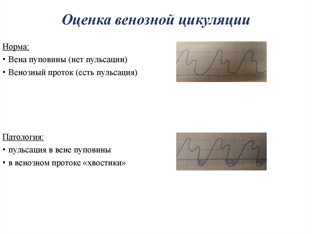 Пульсация в вене. Пульсация венозного протока норма. Пульсация в Вене пуповины. Оценка результатов амниоскопии.