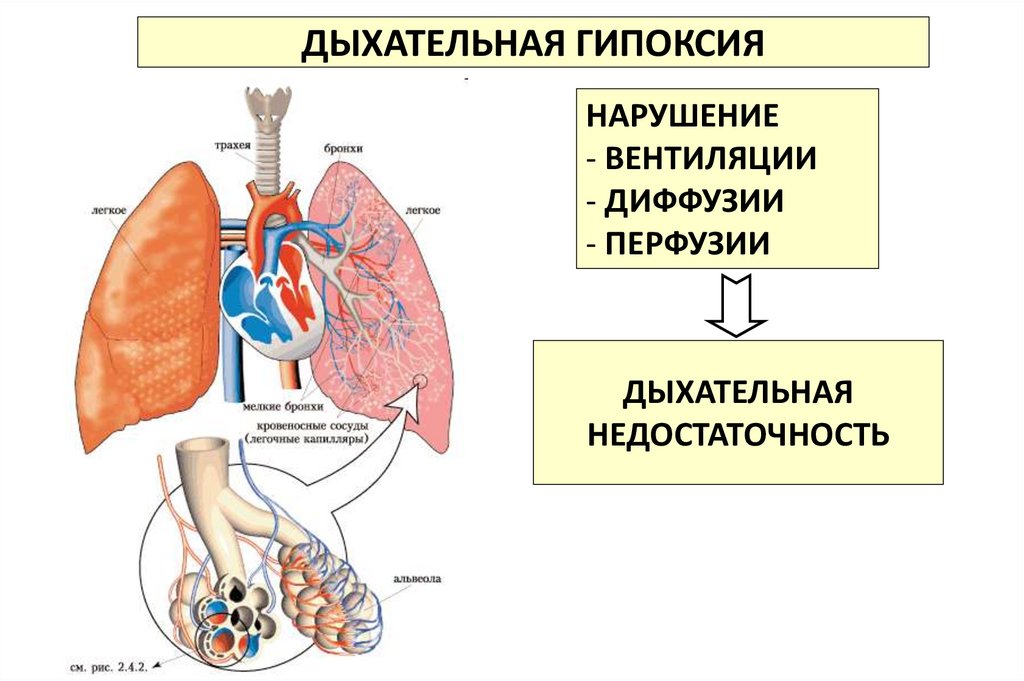 Причины нарушения дыхания. Дыхательная (респираторная, легочная) гипоксия. Респираторный Тип гипоксии. Дыхательная система при гипоксии. Гипоксическая дыхательная недостаточность.