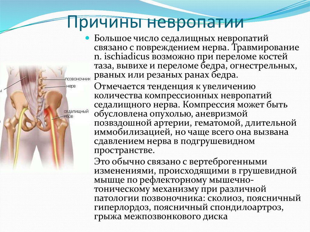 Нейропатии это что такое у женщин. Невропатия седалищного нерва. Синдром невропатии. Невропатия нервов нижних конечностей.