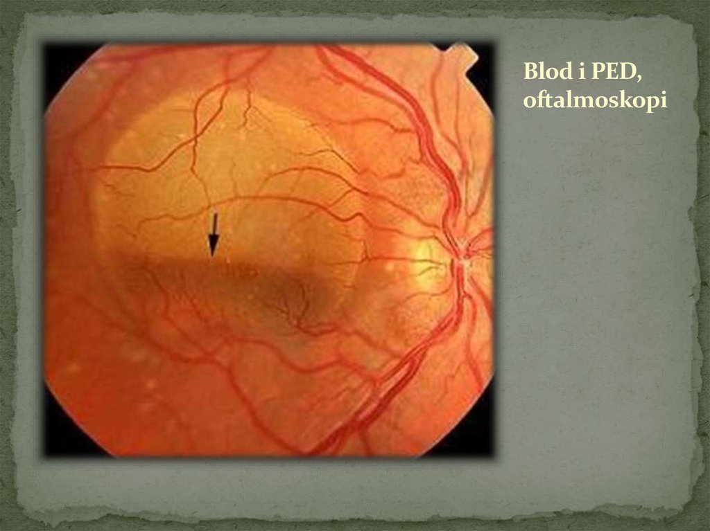 Blod i PED, oftalmoskopi