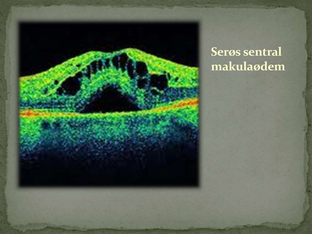 Serøs sentral makulaødem