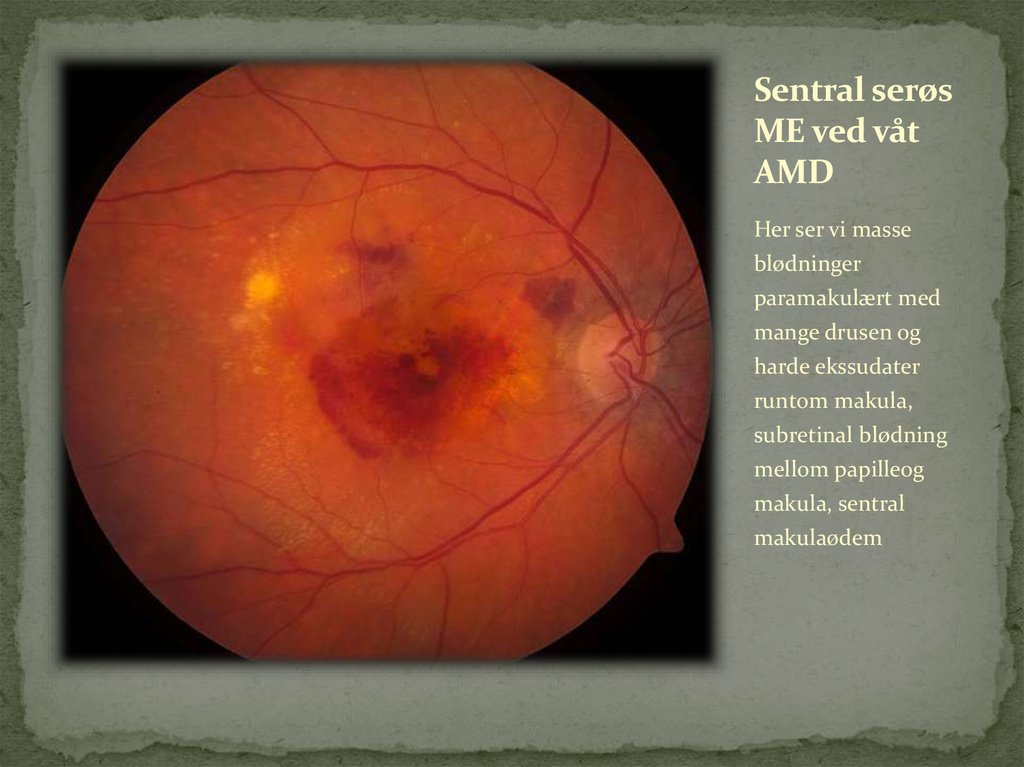 Sentral serøs ME ved våt AMD