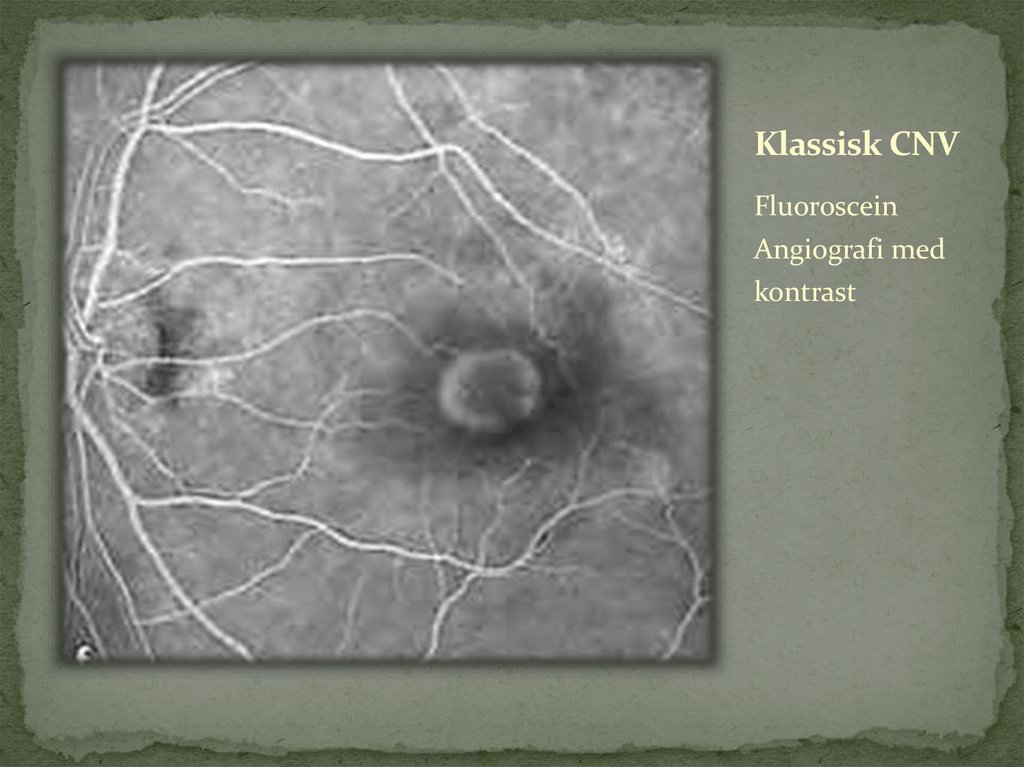 Klassisk CNV