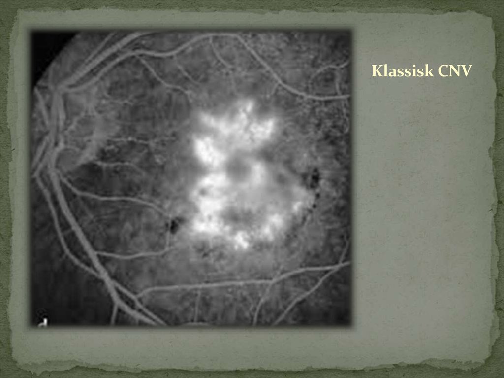 Klassisk CNV