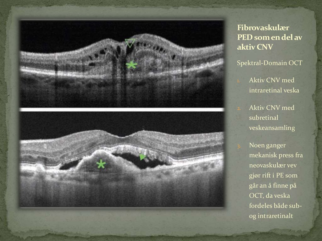 Fibrovaskulær PED som en del av aktiv CNV