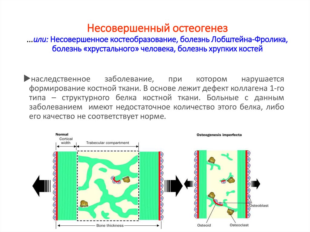 Несовершенные. Незавершенный остеогенез 1 Тип. Несовершенный остеогенез патогенез. Несовершенный остеогенез этиология. Болезнь несовершенный остеогенез.