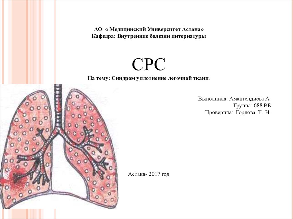 Уплотнение легочной ткани. Синдром очагового уплотнения легочной ткани патогенез. Очаговое воспалительное уплотнение легочной ткани. Синдром долевого уплотнения легочной ткани. Синдром уплотнения легочной ткани долевая пневмония.