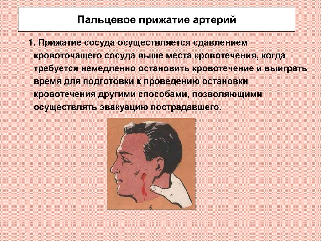 Прижатие сонной артерии. Пальцевое прижатие сонной артерии. Паьцевое пережатие артерий. Пальцевое прижатие сонной артерии производится. Пальцевое прижатие сонной арте.