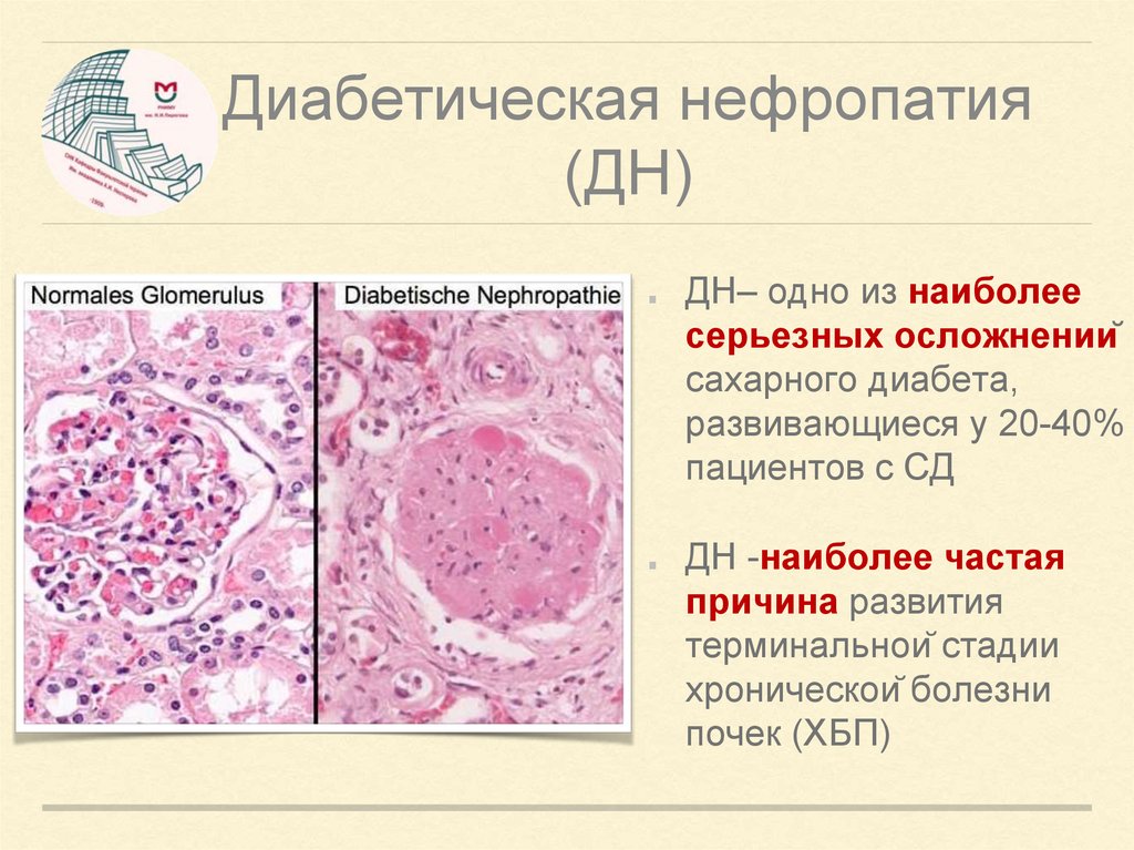 Фото диабетическая нефропатия