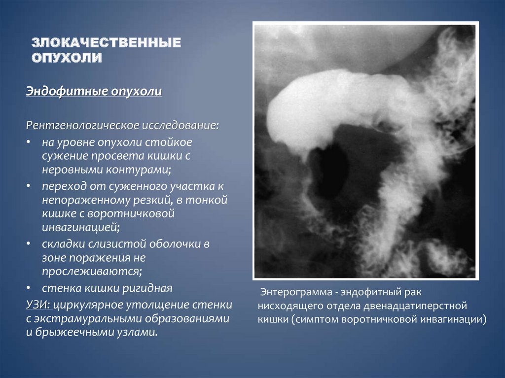 Опухоль подвижна. Злокачественная опухоль. Злокачественные новообразования. Рентгенологические признаки злокачественной опухоли. Злокачественные новообразования кратко.