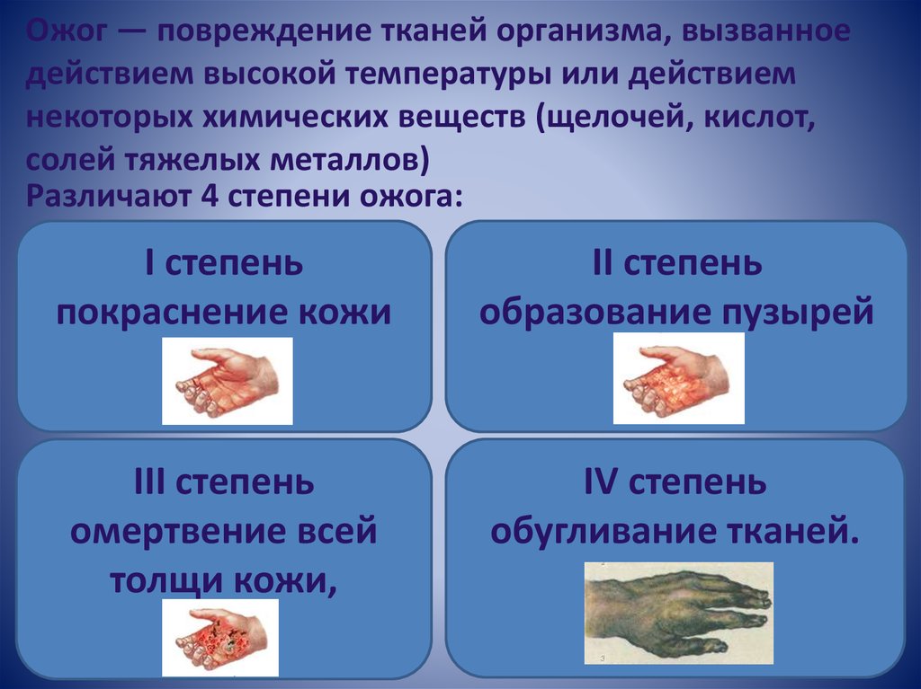 Оказание первой медицинской помощи при ожогах презентация