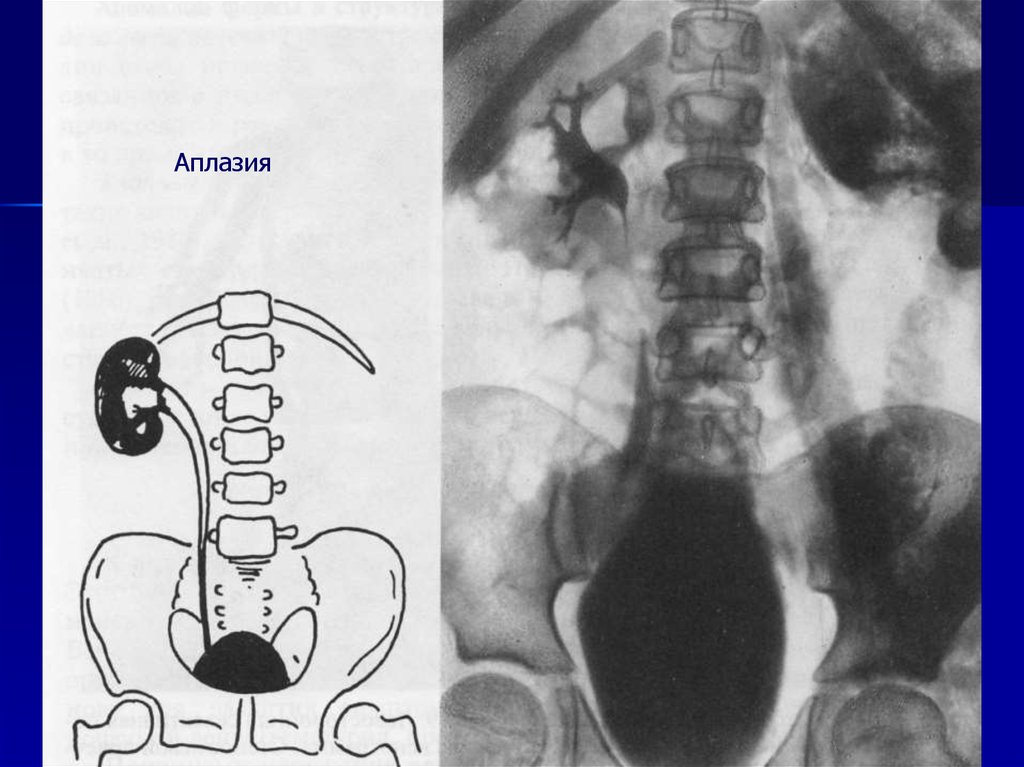 Отсутствие органа. Агенезия и аплазия почки. Агенезия почки односторонняя. Аплазия левой почки на кт. Аплазия (агенезия) мочеточника.