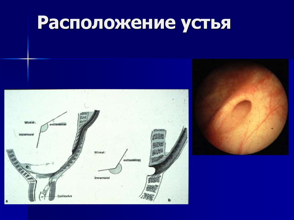 Аномалии развития мочеполовой