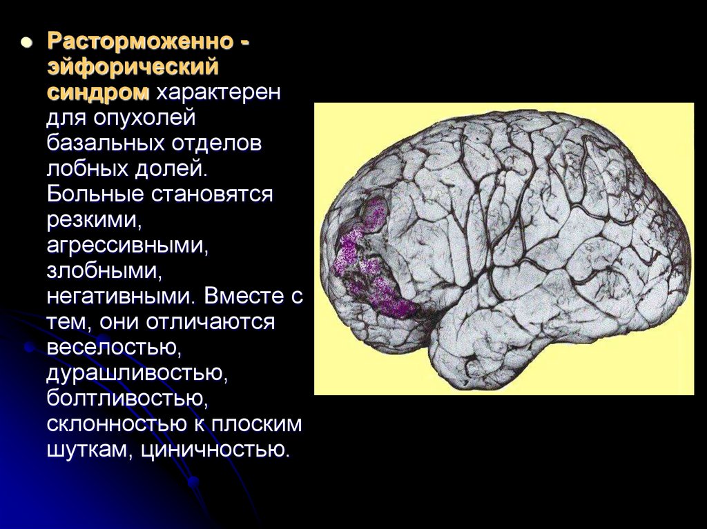 Болезни мозга названия. Синдромы повреждения лобных долей мозга. Опухоль лобной доли головного мозга. Опухоль лобной доли синдром. Опухоль лобной доли головного мозга неврология.