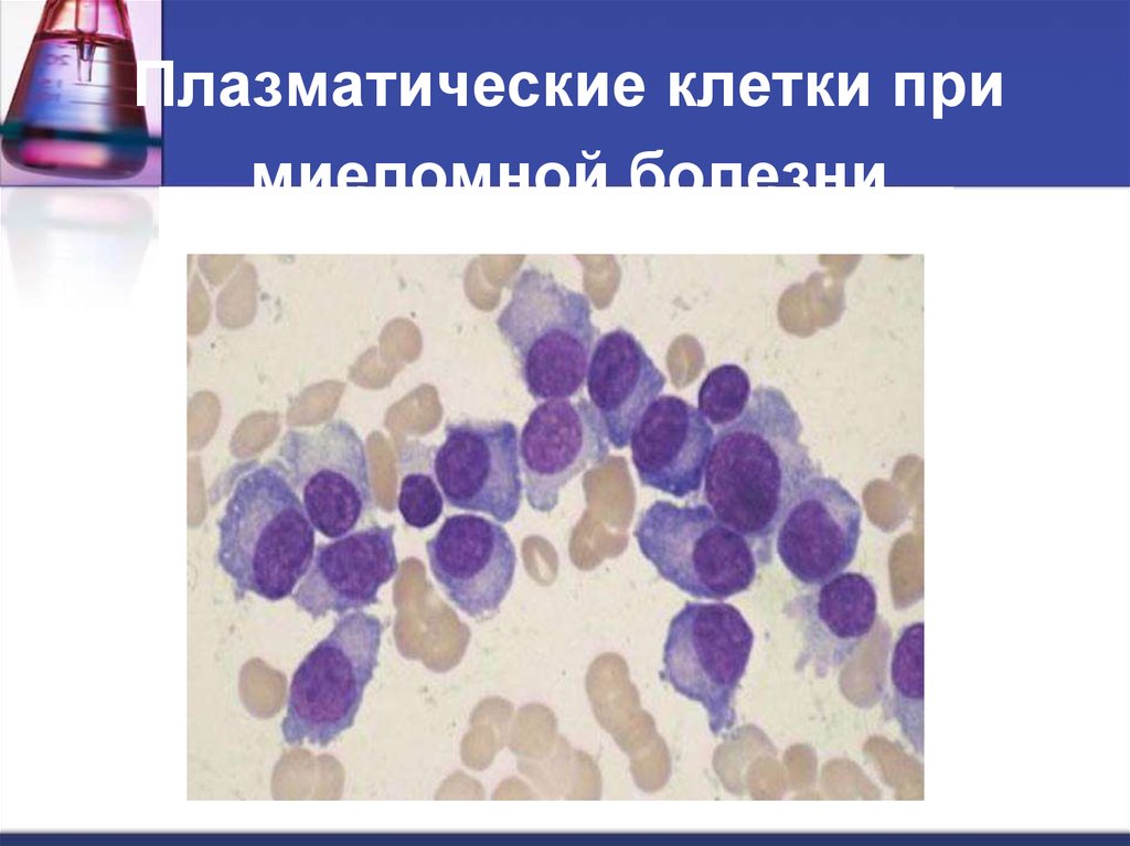 1 плазматическая клетка. Плазматические клетки плазмоциты. Миеломная болезнь плазматические клетки. Плазматические клетки при миеломе. Плазматические клетки в мазке крови.
