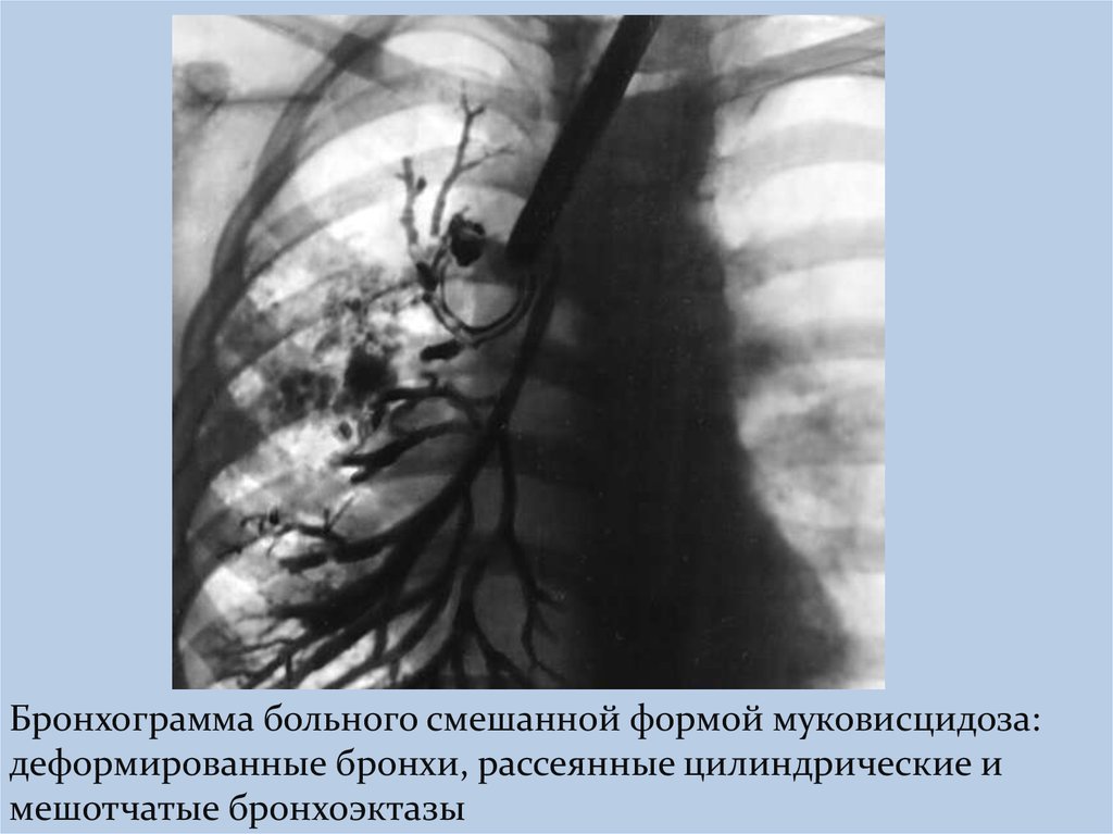 Кистозный фиброз презентация