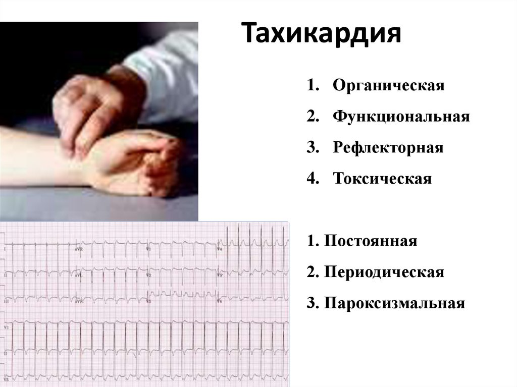 Тахикардия что это. Тахикардия. Тахикардия симптомы. Симптомы при тахикардии. Тахикардия симптомы и причины.